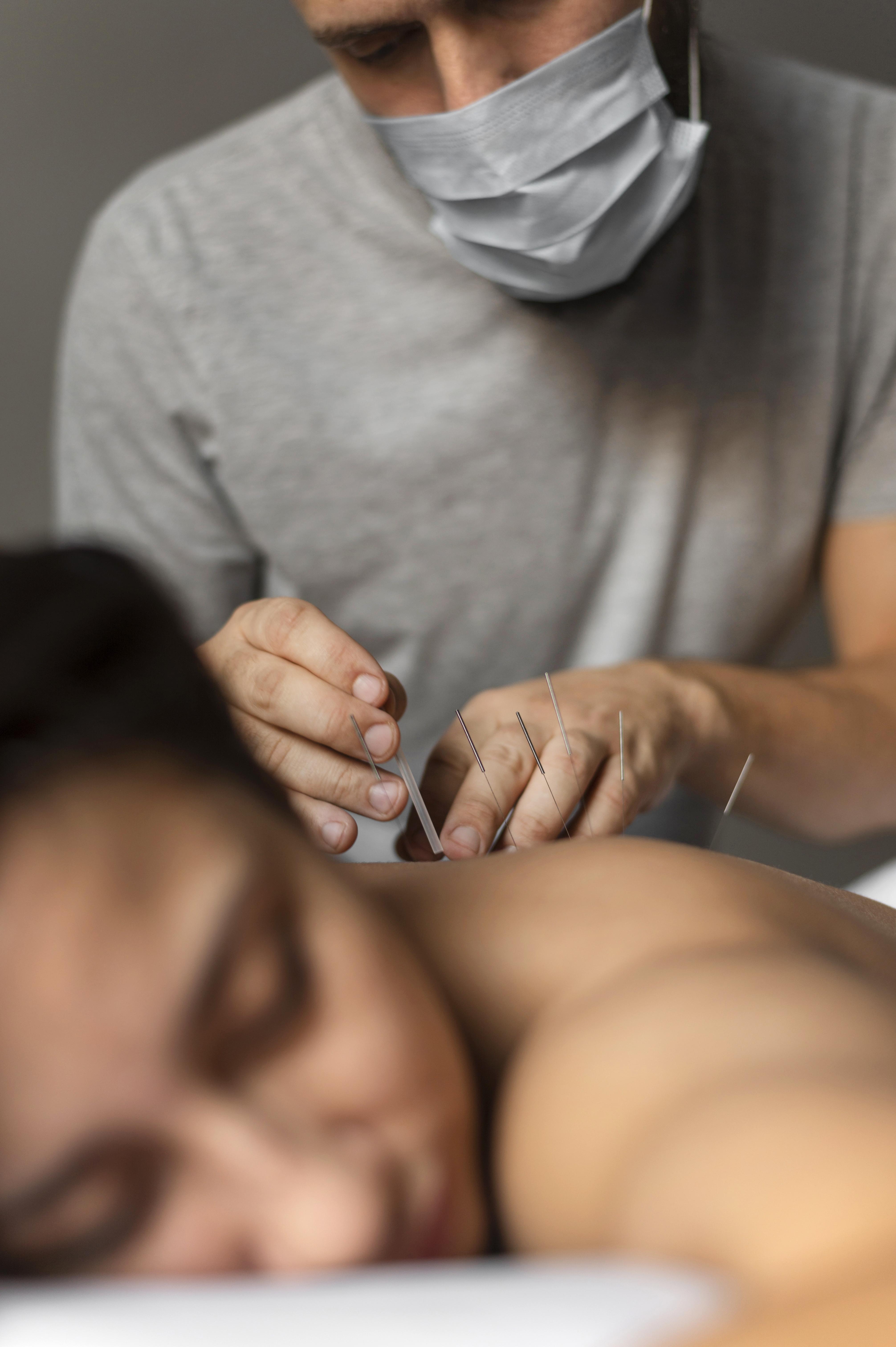 Acupuncture