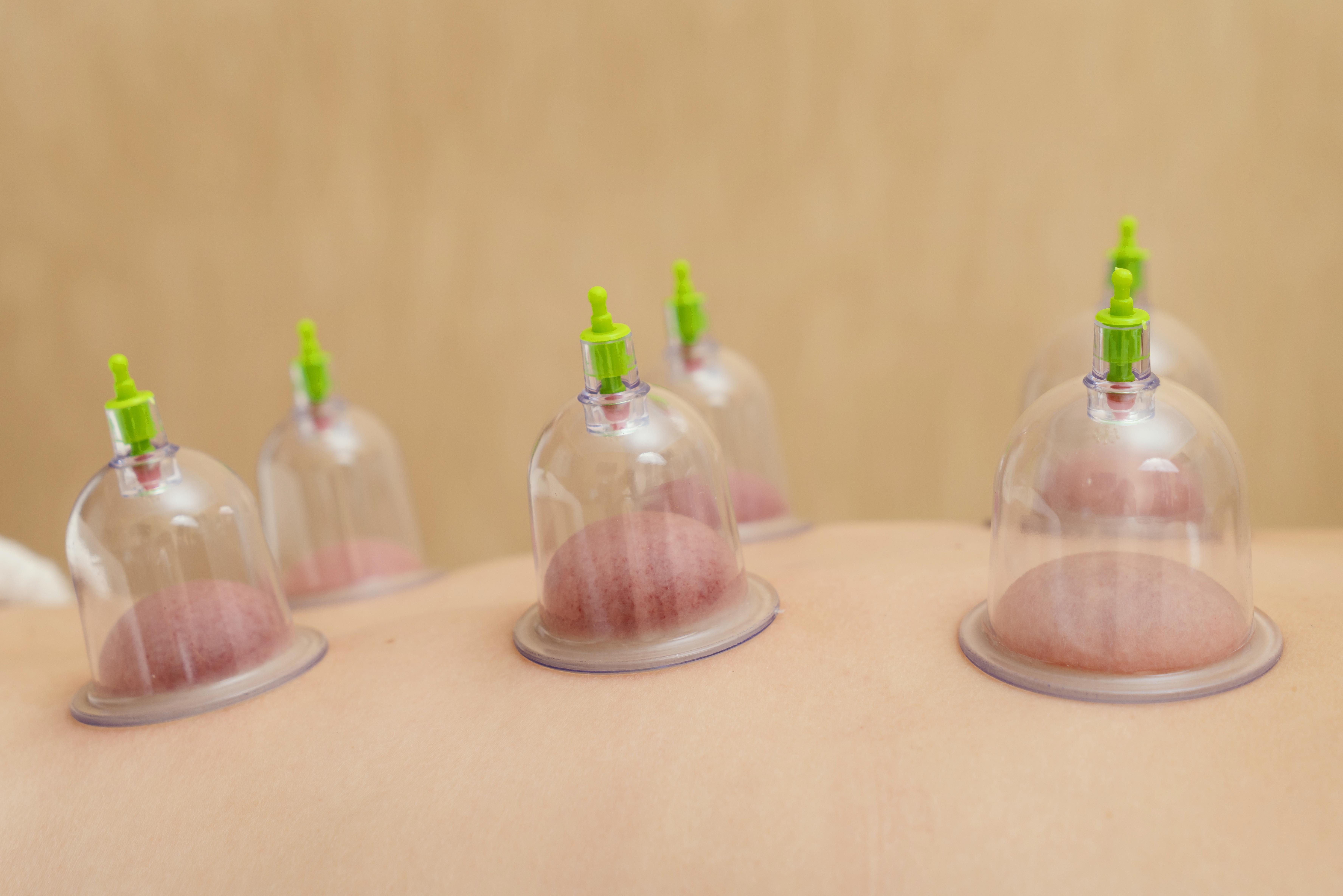 Cupping